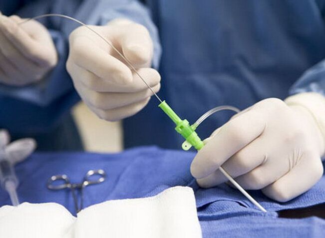 Radiofrekvences ablācija